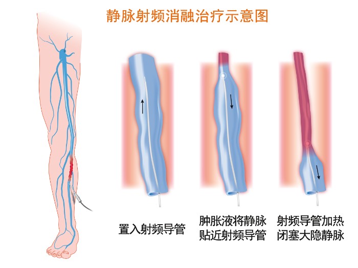 治疗示意图.jpg 治疗示意图.jpg