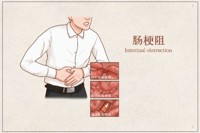 摄图网_401789691_肠梗阻医疗插画(企业商用).jpg 摄图网_401789691_肠梗阻医疗插画(企业商用).jpg