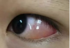 左眼眼球表现.png
